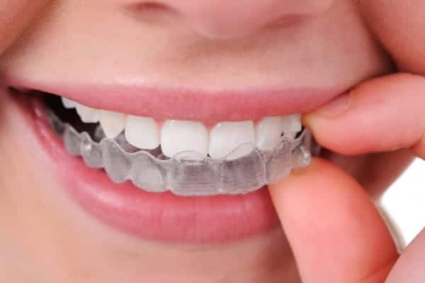 Tratamiento Invisalign - Clínica Dental en Valencia Benimaclet