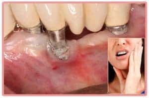 Rechazo Implante Dental | Clínica Dental Artdenta Valencia