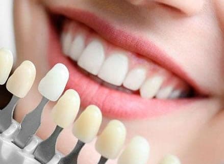 Carillas dentales y Fluorosis | Clínica Dental Artdenta Valencia
