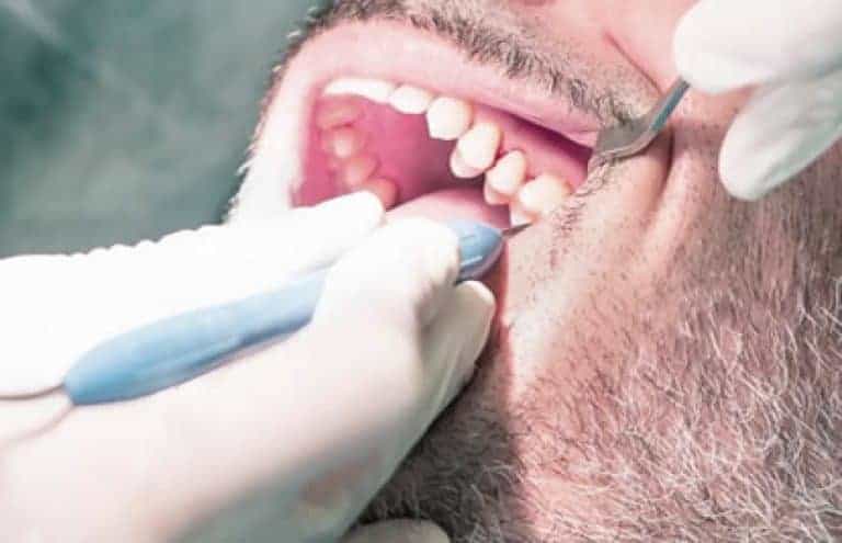 Sarro Negro Qu Es C Mo Se Forma Cl Nica Dental En Valencia