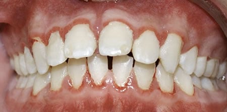 Enfermedad Gingival | Periodoncia | Clínica Dental Artdenta en Valencia