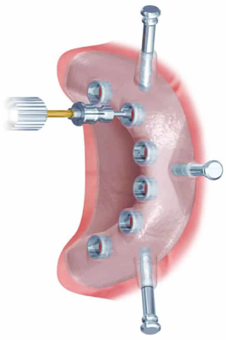 Implantes de carga inmediata Que son intervención beneficios