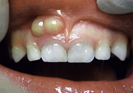 Urgencias Dentales 24 horas por Abscesos Dentales | Clínica Dental Artdenta Valencia