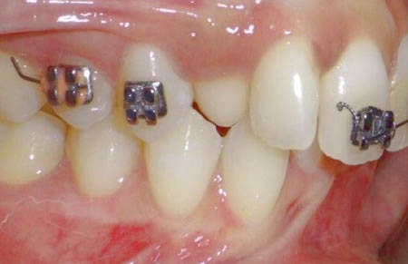 Urgencia Dental 24 horas por brackets roto | Clínica Dental Artdenta Valencia
