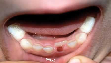 Urgencias Dentales 24 horas por Diente Caído| Clínica Dental Artdenta Valencia