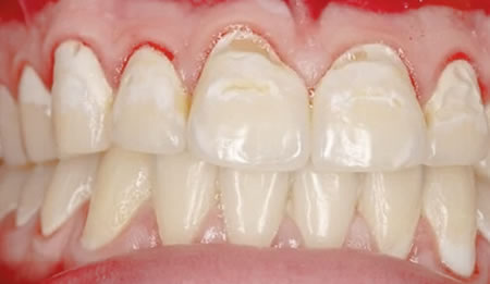 Urgencia Dental 24 horas por Encías Sangrantes| Clínica Dental Artdenta Valencia