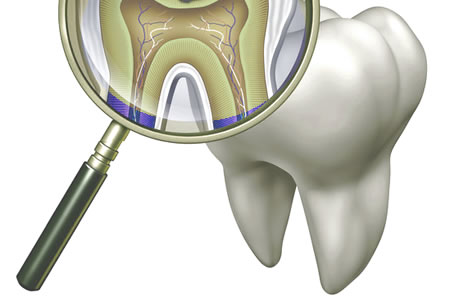 Las caries y el flúor | Clínica Dental Artdenta Valencia