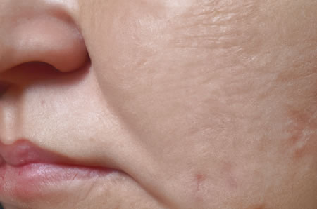 Mejilla hinflamada Celulitis Facial Odontogénica | Clínica Dental Artdenta Valencia