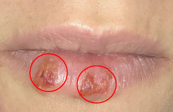 Herpes Labial | Clínica Dental Artdenta Valencia
