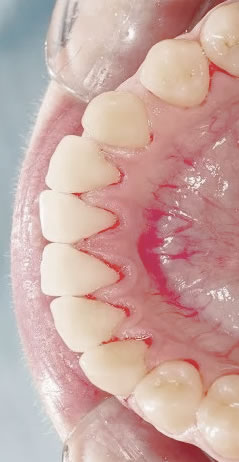 Clorhexidina e inflamación tejido dental | Clínica Dental Artdenta Valencia