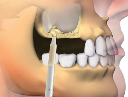 Elevación Senos paranasales - Injerto dental | Clínica Dental Artdenta Valencia