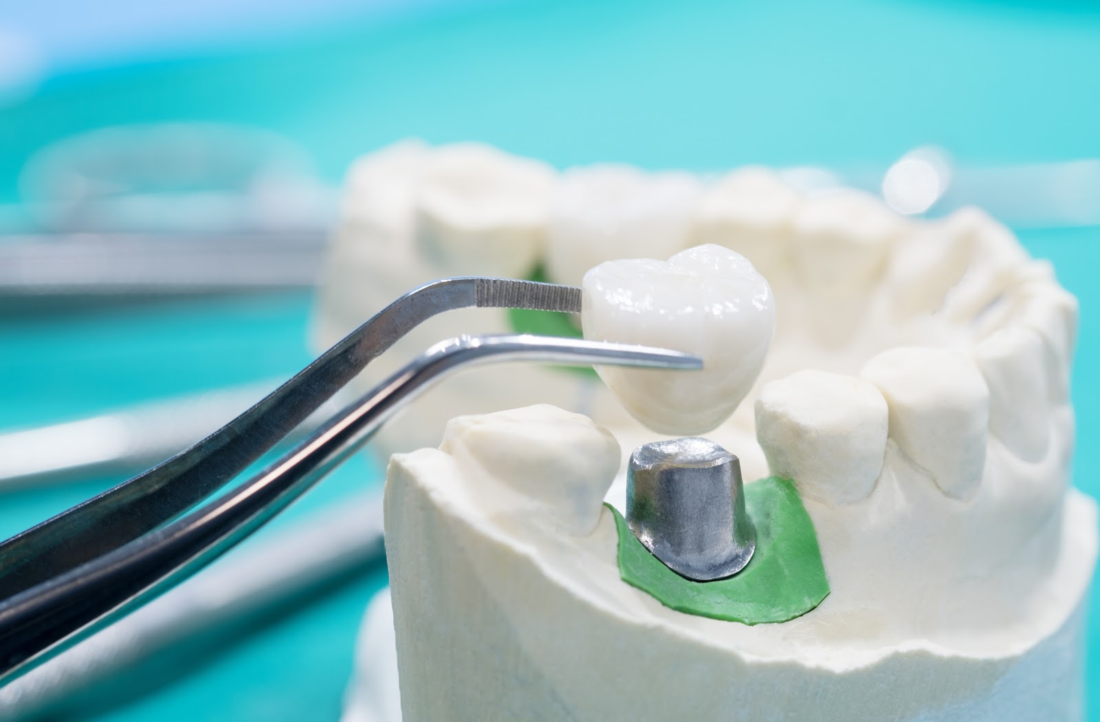 Implantes - Injerto dental | Clínica Dental Artdenta Valencia