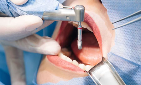 Cirugía de Osteointegración| Clínica Dental Artdenta Valencia