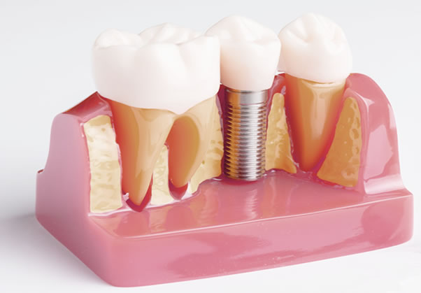 Implante Dental | Clínica Dental Artdenta Valencia