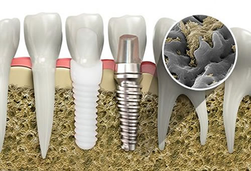 Osteointegración dental | Clínica Dental Artdenta Valencia