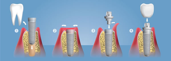 Pasos de la implantación dental | Clínica Dental Artdenta Valencia