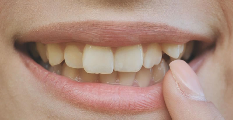 Dientes apiñados | Clínica Dental Artdenta Valencia