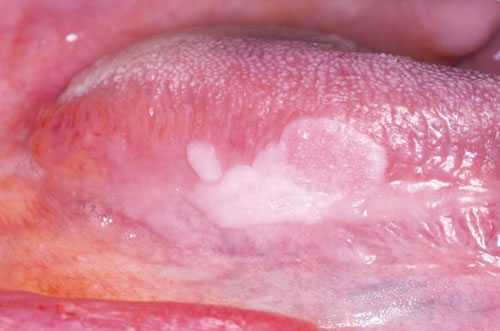Leucoplasia en boca | Dental Artdenta Valencia