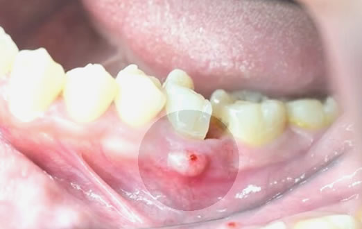 Absceso Dental | Clínica Dental Artdenta Valencia
