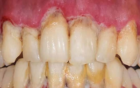 Mala Higiene Dental | Clínica Dental Artdenta Valencia
