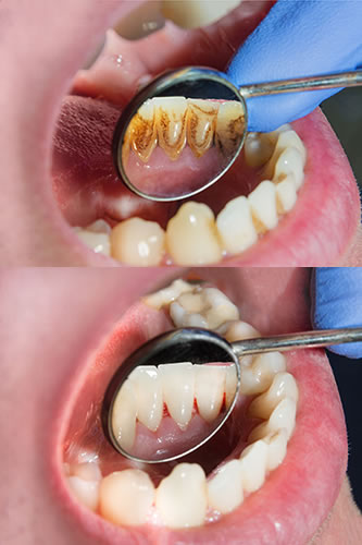 Taaco y Curetaje Dental | Dental Artdenta Valencia