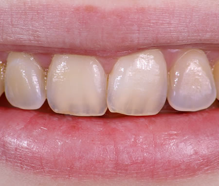 Desgaste Empaste Dental | Clínica Dental Artdenta Valencia