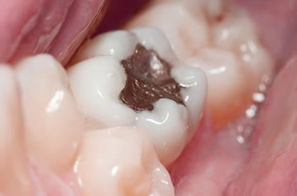 Caries Dental | Clínica Dental Artdenta Valencia
