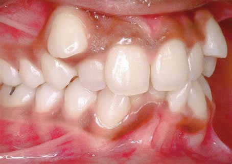 Maloclusión dental | Disyuntor Dental | Clínica Dental Artdenta Valencia