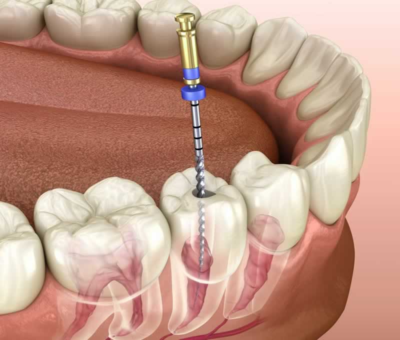 Endodoncia Perno Dental | Clínica Dental Artdenta Valencia