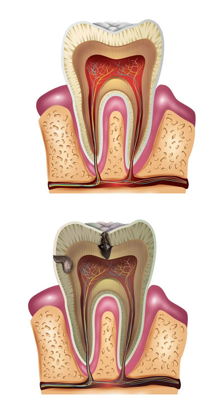 Nervio afectado Perno Dental | Clínica Dental Artdenta Valencia