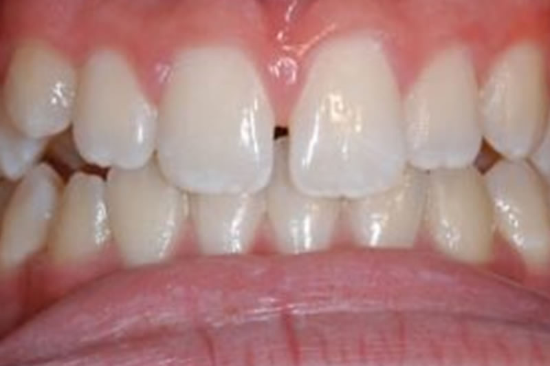 Dientes con Fluorosis | Clínica Dental Artdenta Valencia