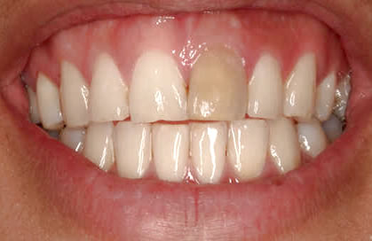 Decoloración dental| Clínica Dental Artdenta Valencia