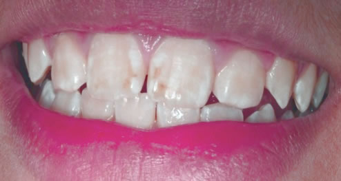 Hipoplasia dental | Clínica Dental Artdenta Valencia