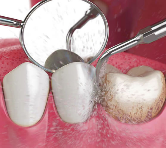 Revisión dental | Clínica Dental Artdenta Valencia