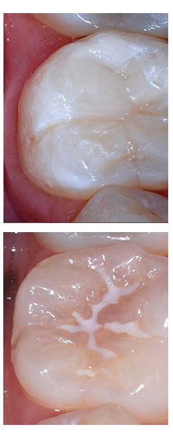 Sellado dental| Clínica Dental Artdenta Valencia