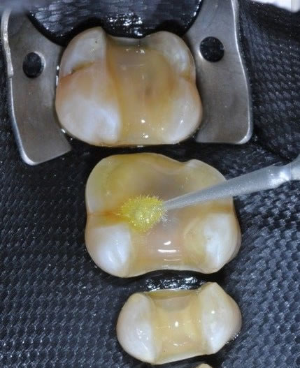 Incrustaciones Dentales de composite | Clínica Dental Artdenta Valencia
