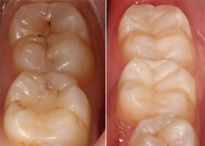 Incrustaciones Dentales | Clínica Dental Artdenta Valencia