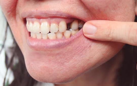 Perdida Dental caso Protésico Dental| Clínica Dental Artdenta Valencia