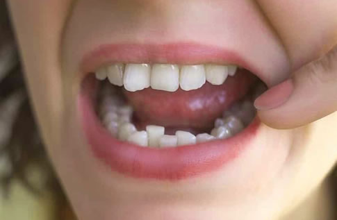Dientes apiñados Arco Dental | Clínica Dental Artdenta Valencia