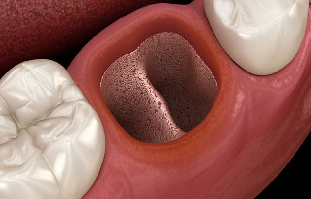 Alveolitis Dental| Clínica Dental Artdenta Valencia
