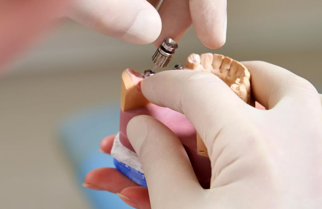 Implante dental en caso de Agenesia | Clínica Dental Artdenta Valencia