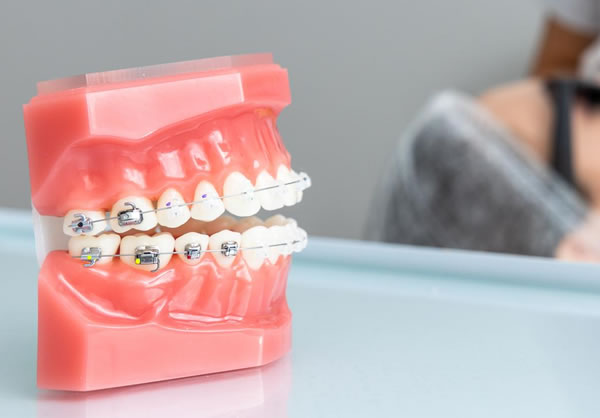 Ortodoncia en casos de Agenesia | Clínica Dental Artdenta Valencia