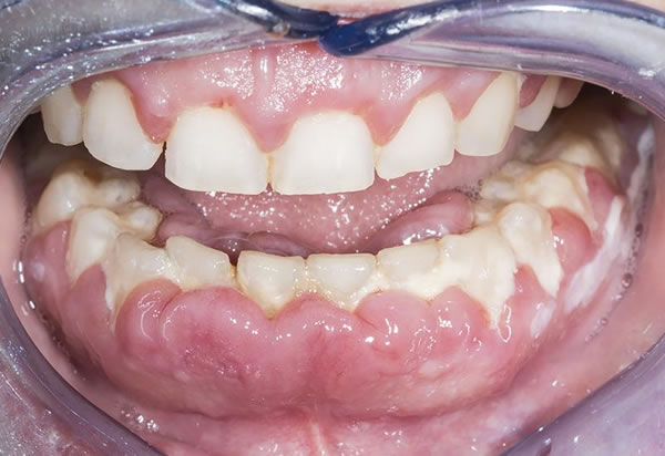 Pulpitis Dental | Clínica Dental Artdenta Valencia