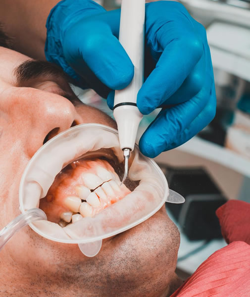 LImpiando sarro con raspadores dentales | Clínica Dental Artdenta en Valencia
