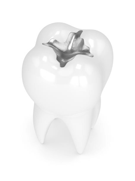 Amalgama dental | Clínica Dental Artdenta Valencia