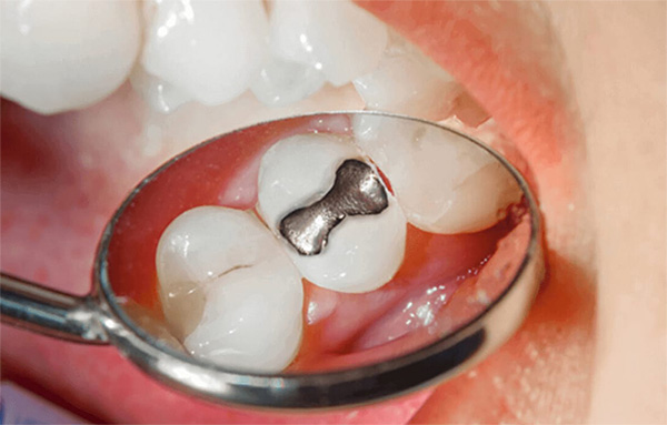 Detalle Amalgama Dental | Clínica Dental Artdenta Valencia