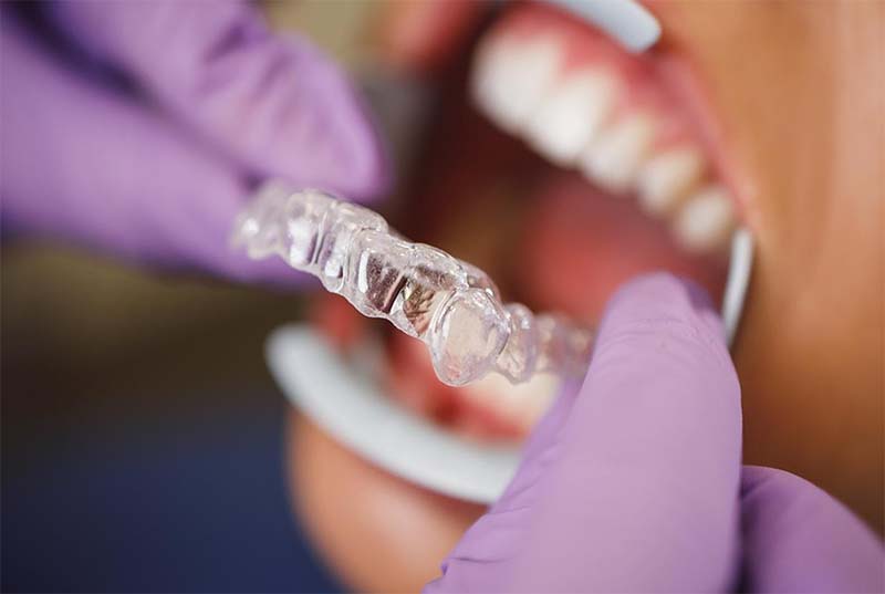 Retenedores Dentales Invisalign | Clínica Dental Artdenta Valencia