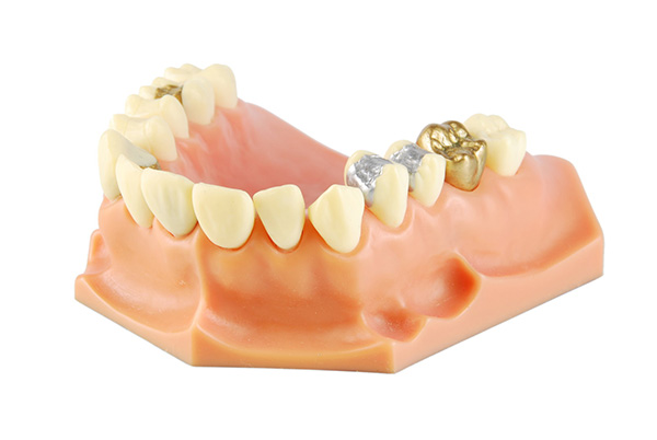 Tipos de amalgama dental | Clínica Dental Artdenta Valencia