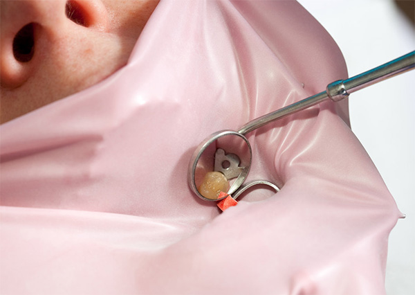 poniendo amalgama dental | Clínica Dental Artdenta Valencia