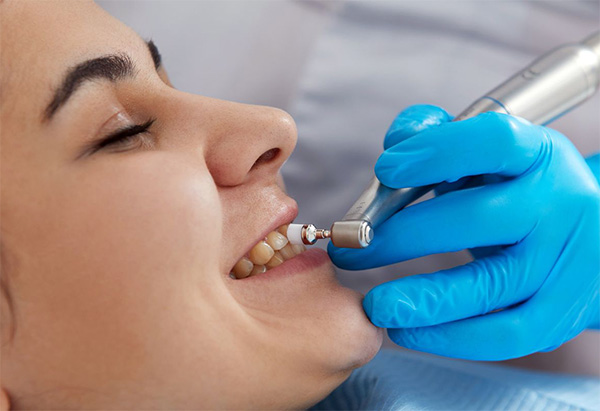 Eliminación de Placa Dental | Clínica Dental Artdenta Valencia